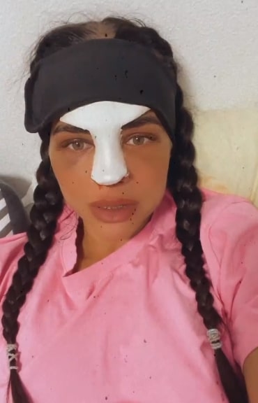 balinskaya rinoplastika